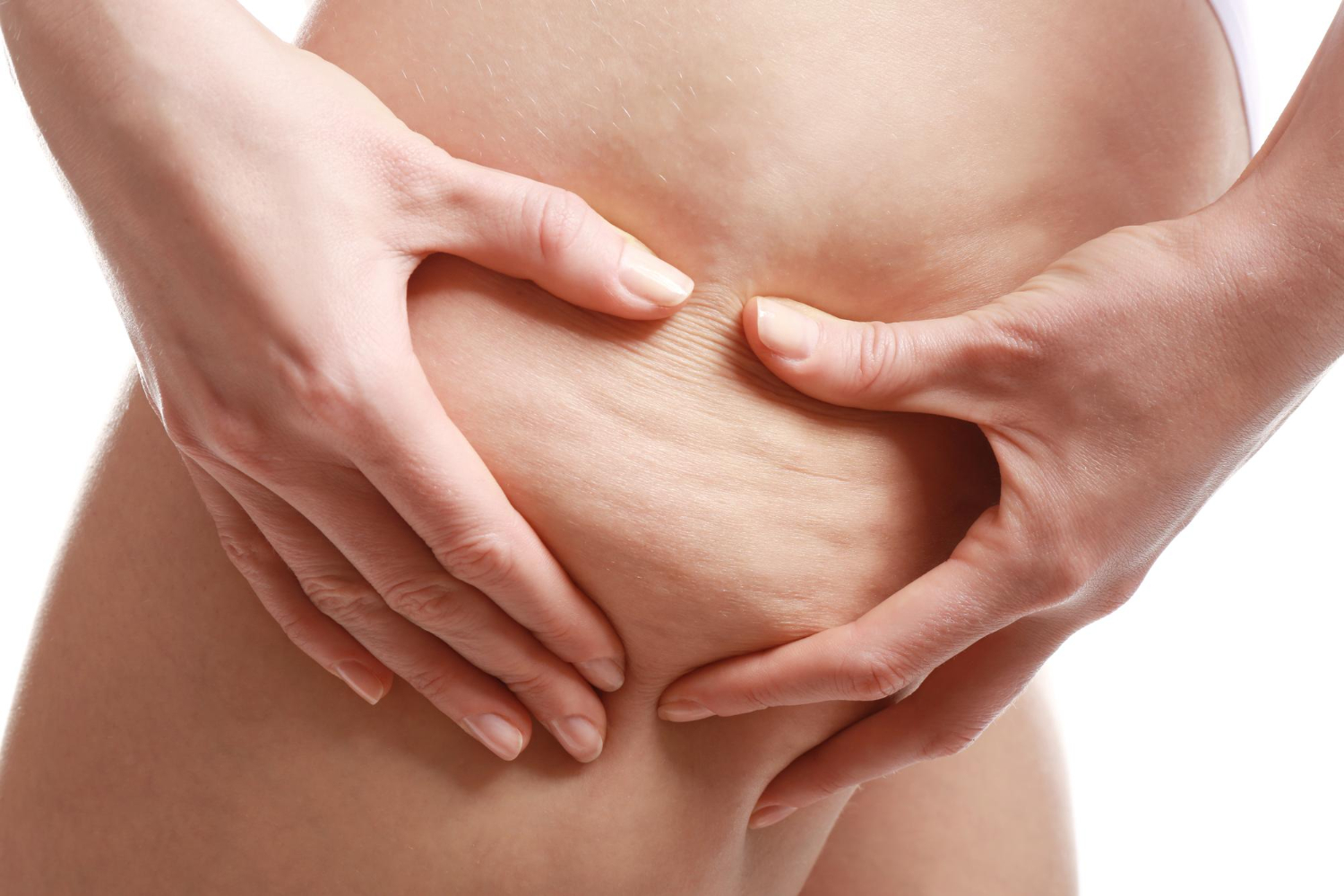 Che cos'è la cellulite